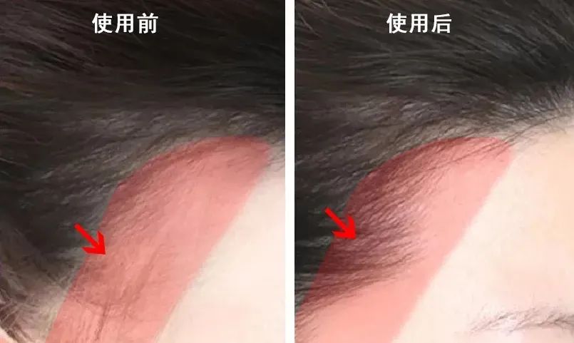 生姜洗头有多好？用了才知道，防脱还控油！99%的人竟然不知道