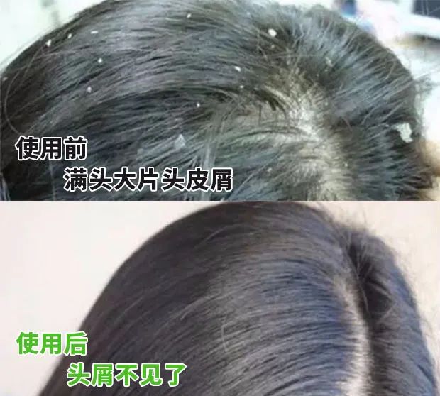 生姜洗头有多好？用了才知道，防脱还控油！99%的人竟然不知道